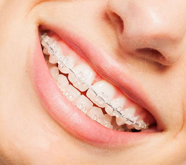 Gilbert Clear Braces