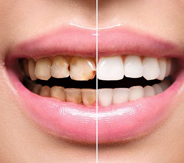 Gilbert Dental Implant Restoration