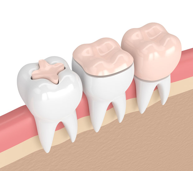 Gilbert Dental Inlays and Onlays