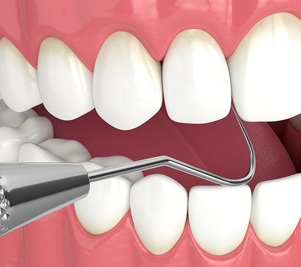 Gilbert Interactive Periodontal Probing