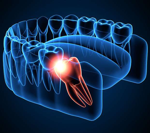 Gilbert Wisdom Teeth Extraction
